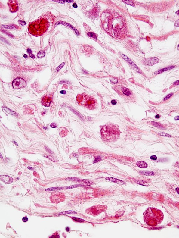 2F3 CMV Neuritis in HIV (Case 2) H&E 1