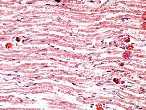 2F4 CMV Neuritis in HIV  (Case 2) H&E 5