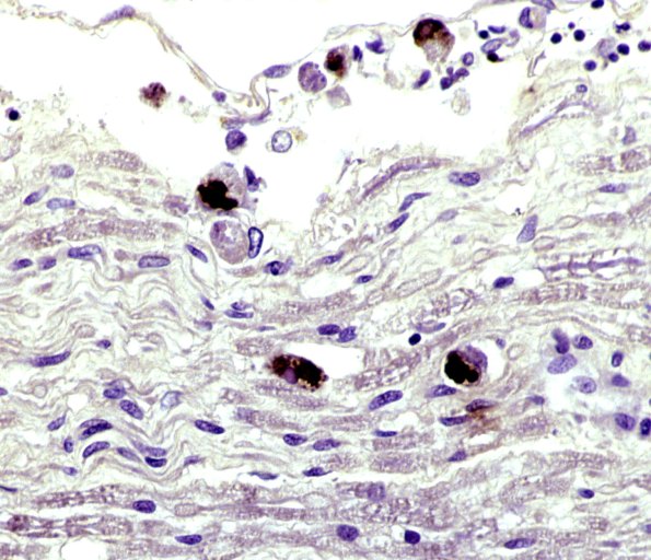 2G CMV Neuritis in HIV (Case 2) Anti-CMV