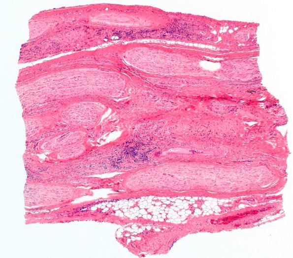 3A1 HIV, Vasculitis (Case 3) H&E 4X 2