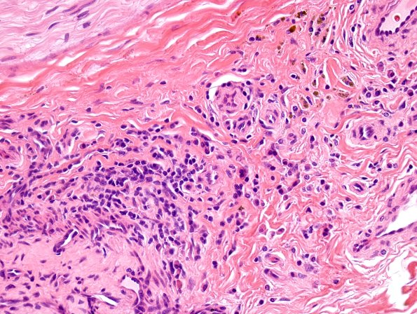 3A2 HIV, Vasculitis (Case 3) H&E 3