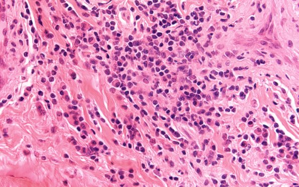 3A3 HIV, Vasculitis (Case 3) H&E 60X 1