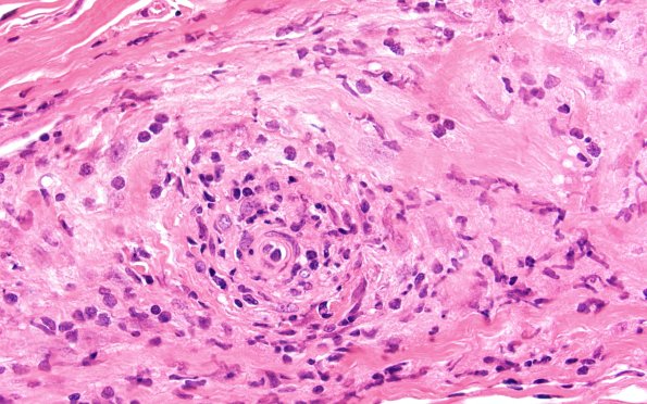 3A4 HIV, Vasculitis (Case 3) H&E 60X 2