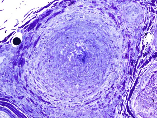 3B2 HIV, Vasculitis (Case 3) Plastic 1