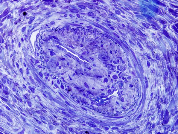 3B3 HIV, Vasculitis (Case 3) Plastic 7