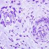 3B6-Vasculitis-HIV-Patient-Case-3-Plastic-7.jpg