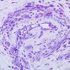 3B7-Vasculitis-HIV-Patient-Case-3-Plastic-12.jpg