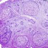 3B8-Vasculitis-HIV-Patient-Case-3-Plastic-2.jpg