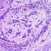 3B9-Vasculitis-HIV-Patient-Case-3-Plastic-6.jpg