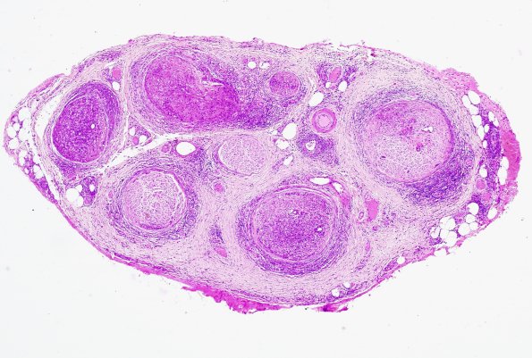 1A1 Leprosy, lepromatous-pluribacillary lepra (Case 1) H&E 14