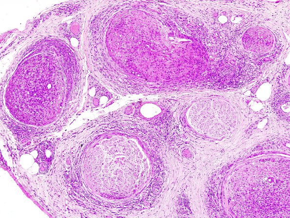1A2 Leprosy, lepromatous-pluribacillary lepra (Case 1) H&E 15