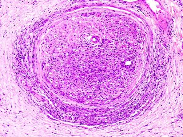 1A3 Leprosy, lepromatous-pluribacillary lepra (Case 1) H&E 16