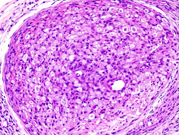 1A4 Leprosy, lepromatous-pluribacillary lepra (Case 1) H&E 20