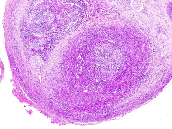 1A5 Leprosy, (Case 1) H&E 1
