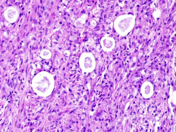 1A8 Leprosy, (Case 1) H&E 6