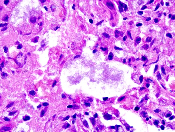 1A9 Leprosy, lepromatous-pluribacillary lepra (Case 1) H&E 27