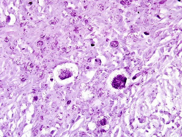 1B1 Leprosy, (Case 1) Fite 6