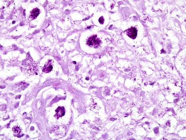 1B2 Leprosy, (Case 1) Fite 12