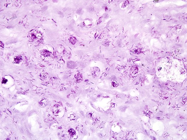 1B3 Leprosy, (Case 1) Fite 16