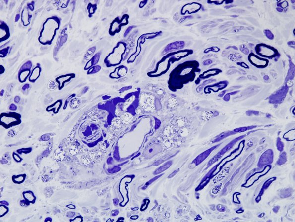 1C5B (Case 1) 100X Plastic 3