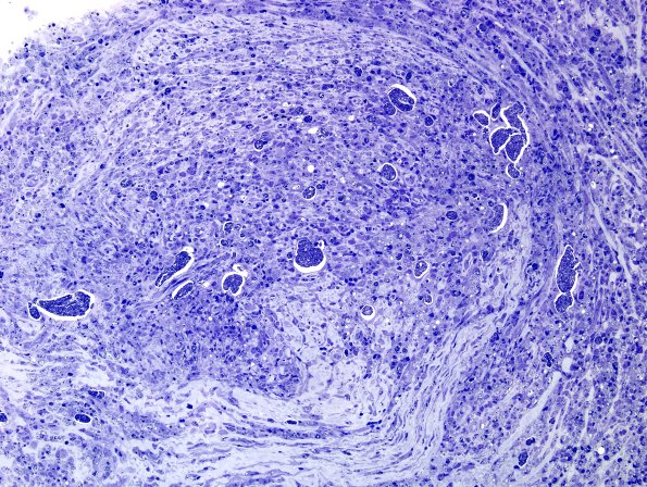 1C6C (Case 1) Plastic 26