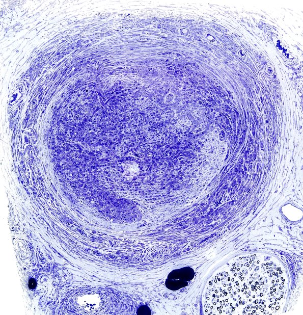 1C7A (Case 1) Plastic 2