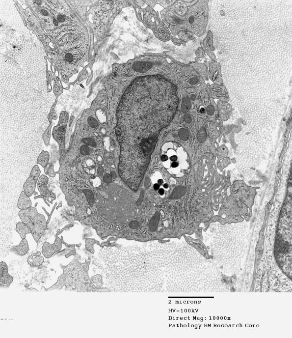 1D10A Leprosy Case 1 EM001 - Copy