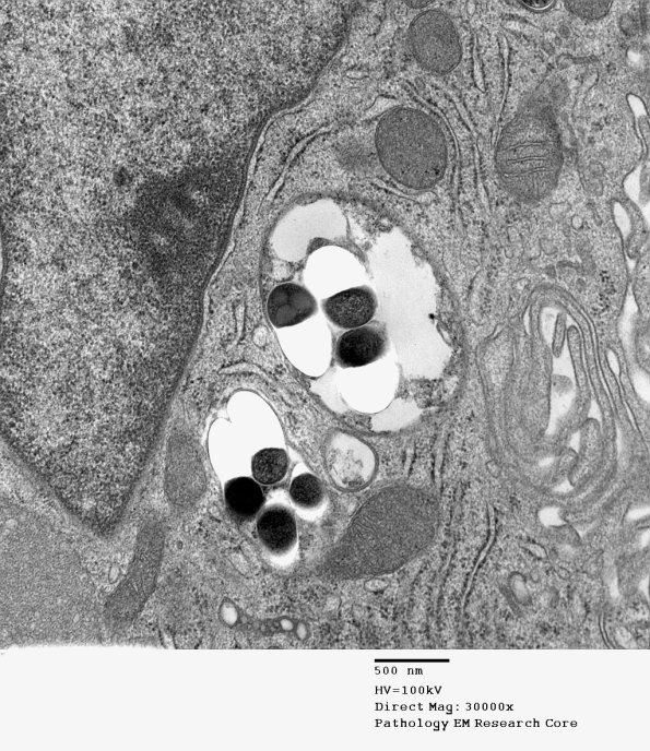 1D10B Leprosy Case 1 EM003 - Copy