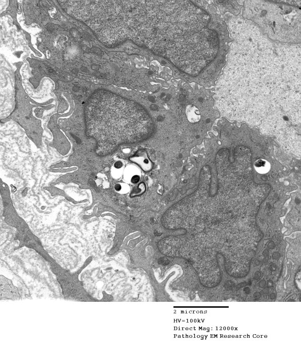 1D12 Leprosy Case 1 EM016 - Copy