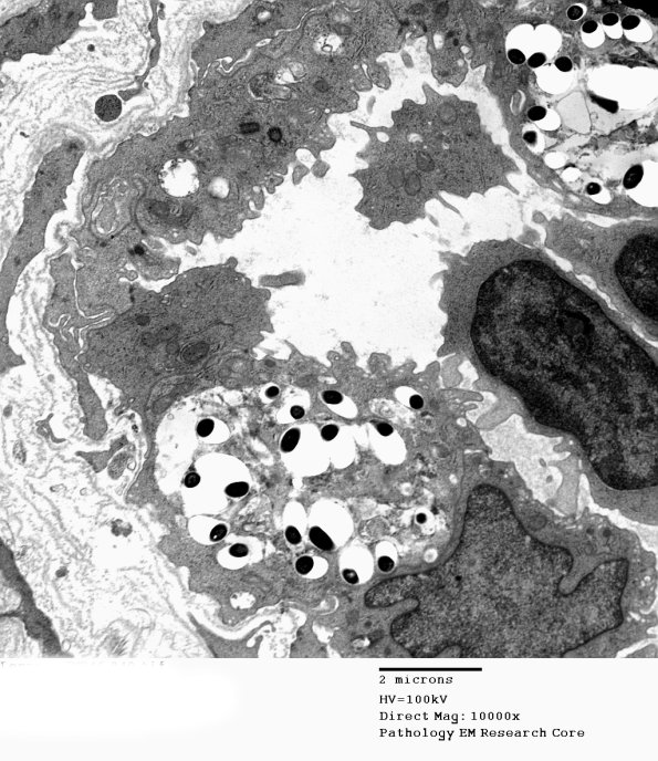1D13 Leprosy Case 1 EM040 - Copy