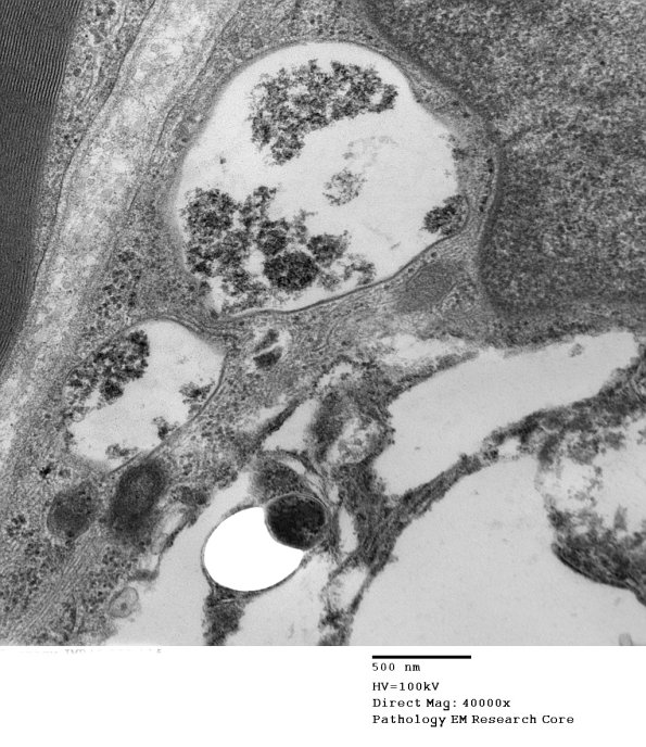 1D15 Leprosy Case 1 EM027 - Copy