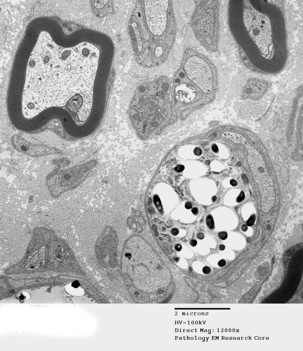 1D1A Leprosy Case 1 EM013 - Copy