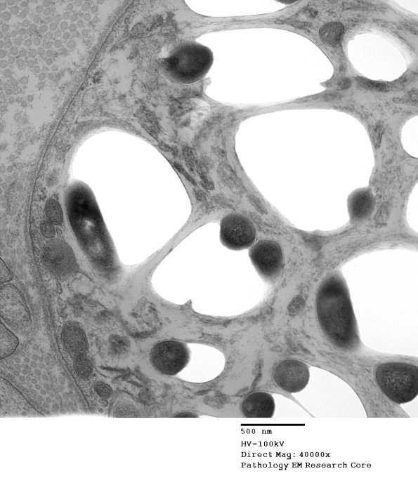 1D1B Leprosy Case 1 EM015 - Copy