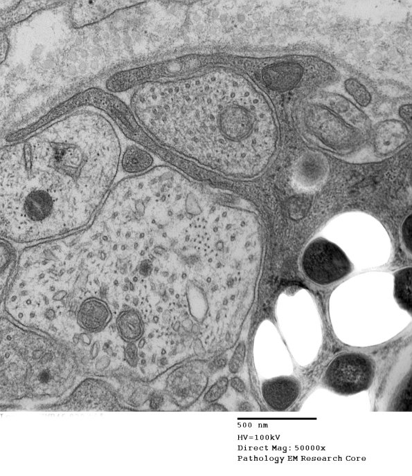 1D3B Leprosy Case 1 EM029 - Copy
