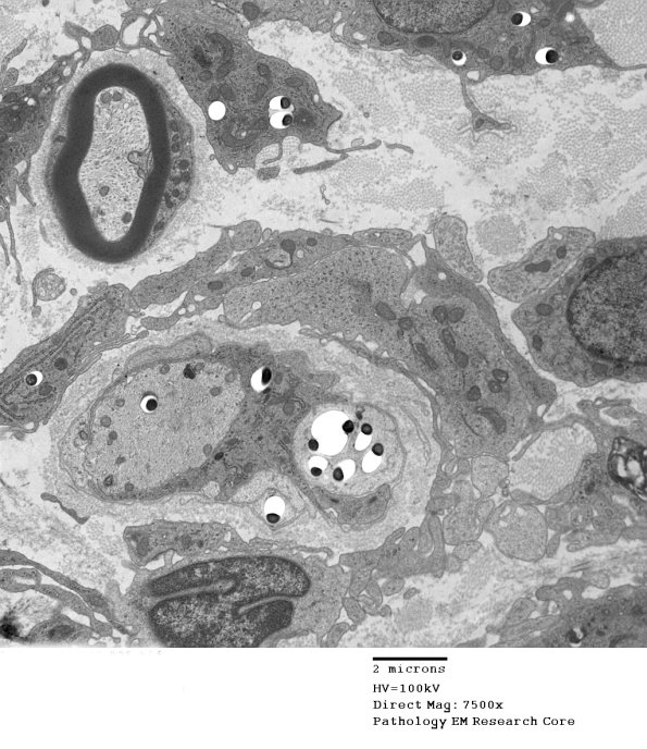 1D4A Leprosy Case 1 EM025 - Copy