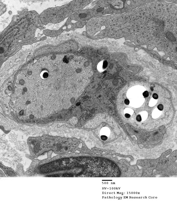 1D4B Leprosy Case 1 EM026 - Copy