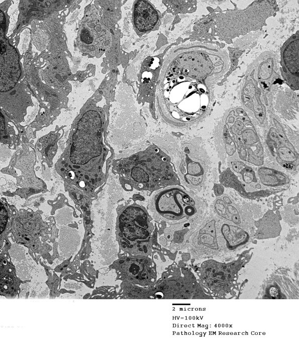 1D5A Leprosy Case 1 EM050 - Copy