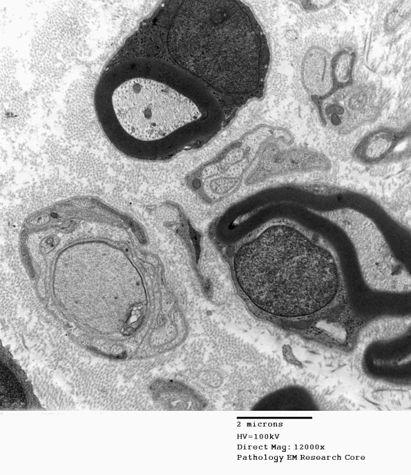 1D6 Leprosy Case 1 EM049 - Copy