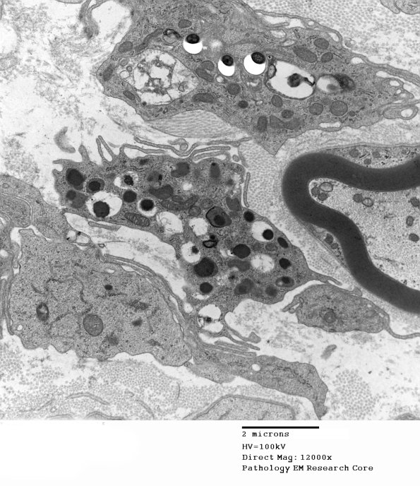 1D9 Leprosy Case 1 EM020 - Copy
