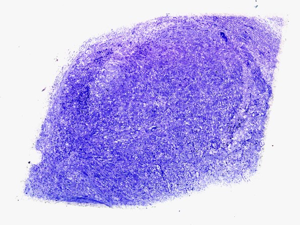 2A1 Leprosy, lepromatous (Case 2) Plastic 1