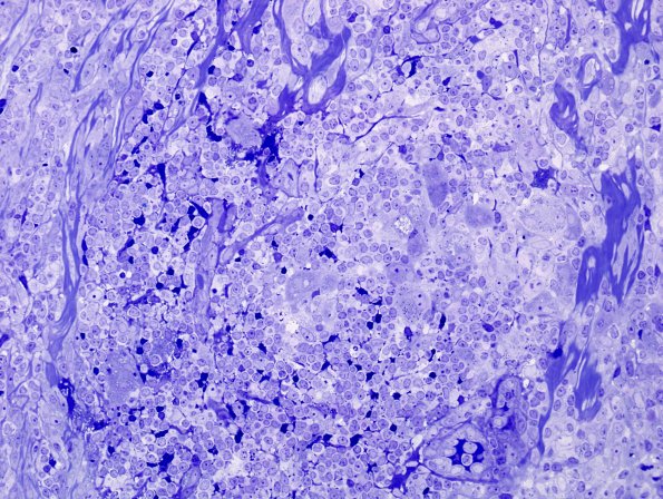 2A2 Leprosy, lepromatous (Case 2) Plastic 2