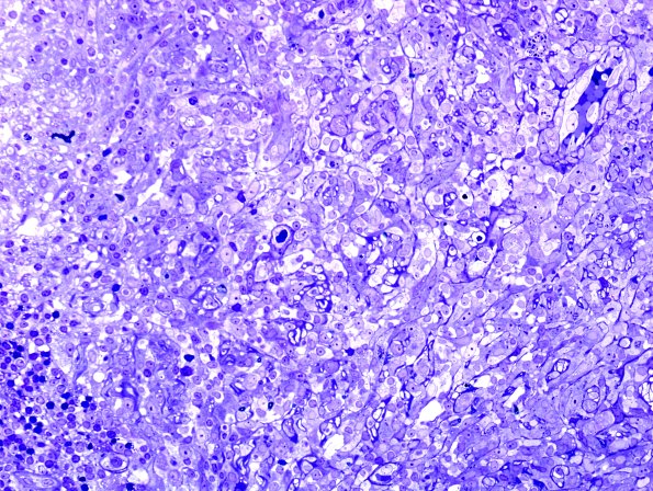 2A3 Leprosy, lepromatous (Case 2) Plastic 4