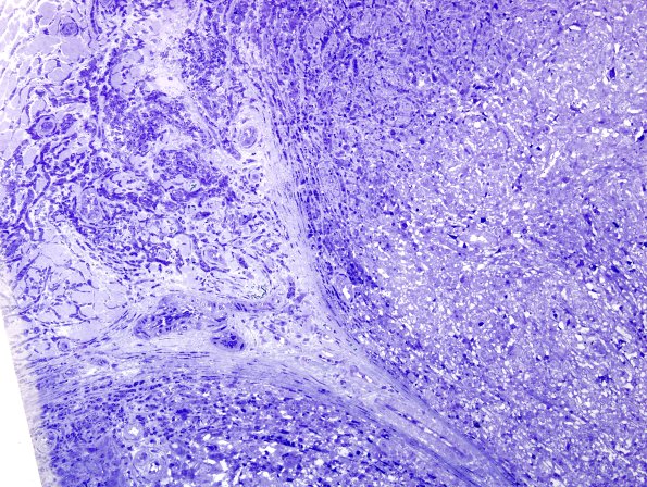 2A4 Leprosy, lepromatous (Case 2) Plastic 5