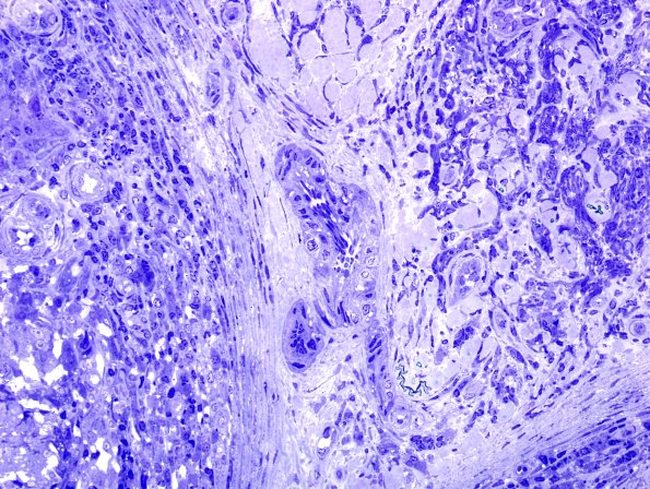 2A5 Leprosy, lepromatous (Case 2) Plastic 7