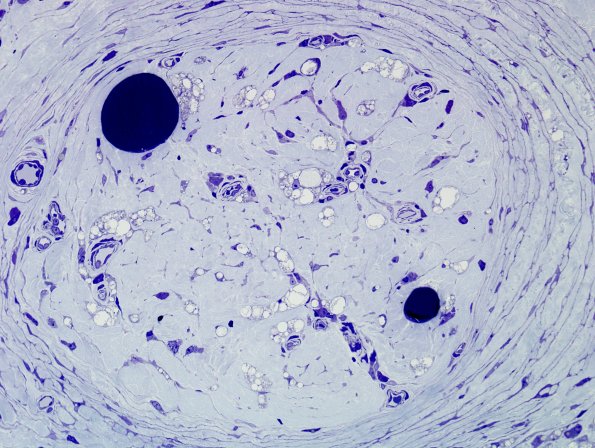 4B2 (Case 4) Plastic 8