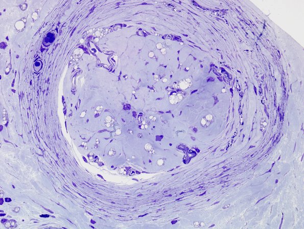 4B3 (Case 4) Plastic 10