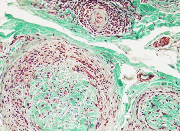 5A Leprosy, lepromatous Trichrome