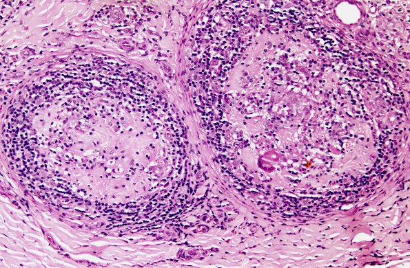 1A2 Leprosy, tuberculoid (Case 1) H&E 10