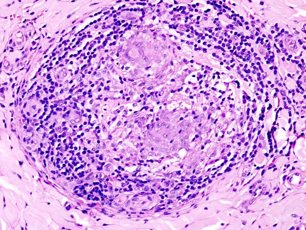 1A3 Leprosy, tuberculoid (Case 1) H&E 2