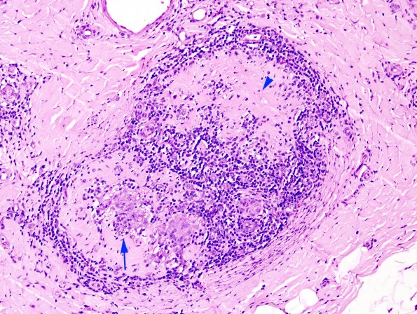 1A4 Leprosy, tuberculoid (Case 1) H&E 3 copy